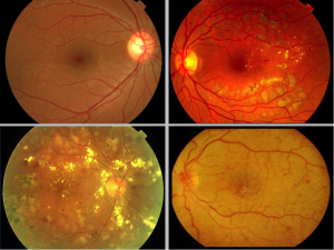 Retinopatía diabética.